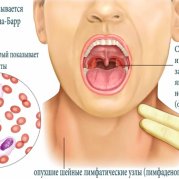 Причины, симптомы и лечение инфекционного мононуклеоза у детей