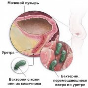 Инфекция мочевыводящих путей или ИМВП у детей: особенности лечения
